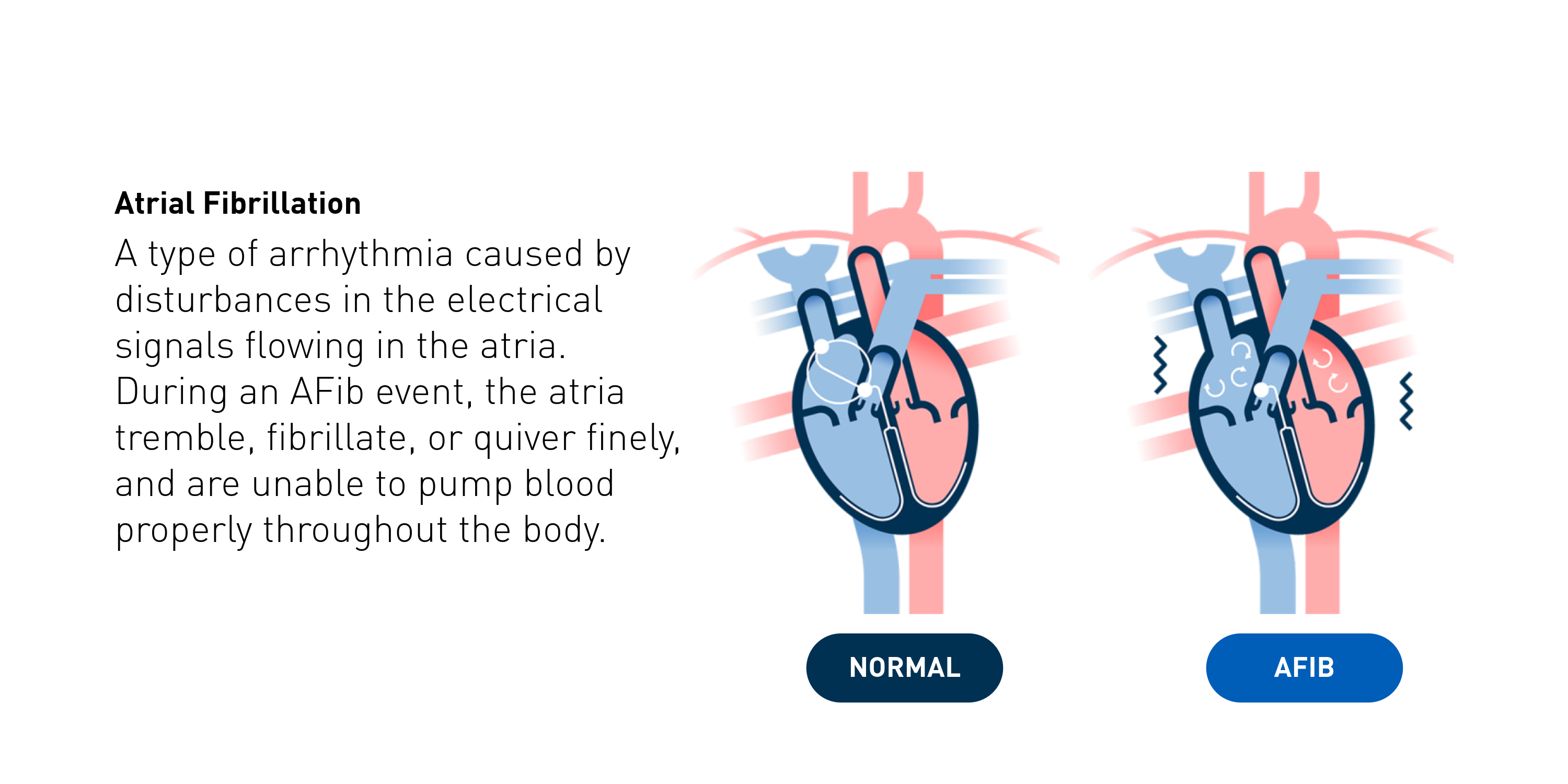 Atrial Fibrillation | A type of arrhythmia caused by disturbances in the electrical signals flowing in the atria. During an AFib event, the atria tremble, fibrillate, or quiver finely, and are unable to pump blood properly throughout the body.