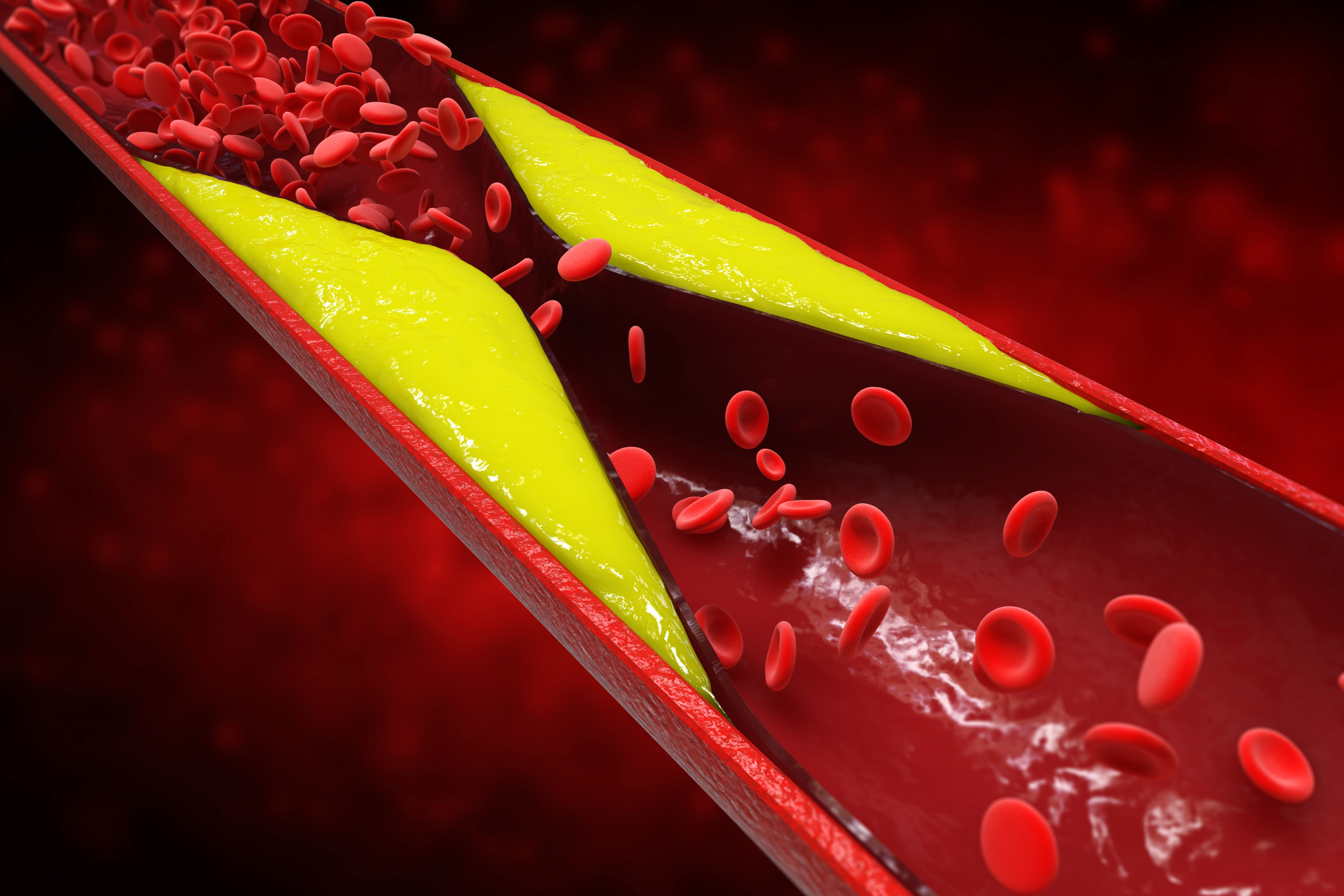 Plaque development in the blood vessels